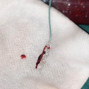 Clot attached to retrieval device after removal from body