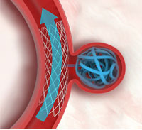 Stent (A Flexible Metal Tube) Assisted Coiling